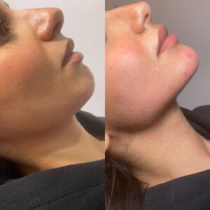 فیلر چانه برای چه کسانی مناسب است؟