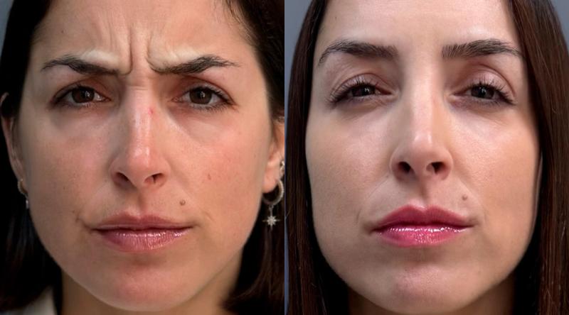 مراقبت های بوتاکس خط اخم