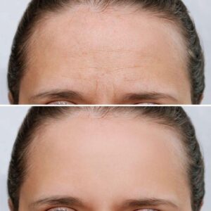 بوتاکس پیشانی چه زمانی اثر می‌کند؟