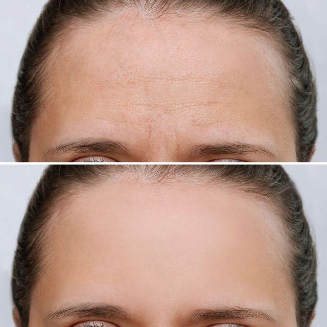 بوتاکس پیشانی چه زمانی اثر می‌کند؟