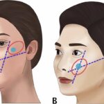 فرم‌دهی گونه (Cheek Contouring)