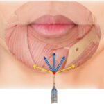 فرم‌دهی چانه (Chin Contouring)