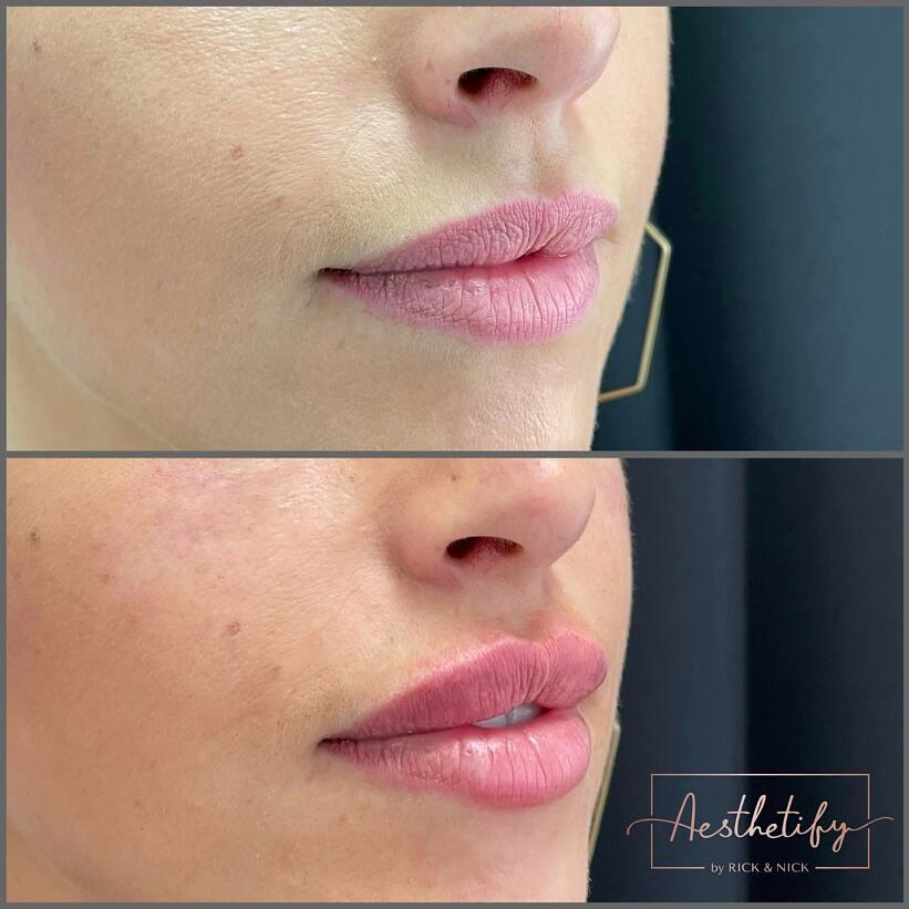 فیلر لب روسی (Russian Lips)