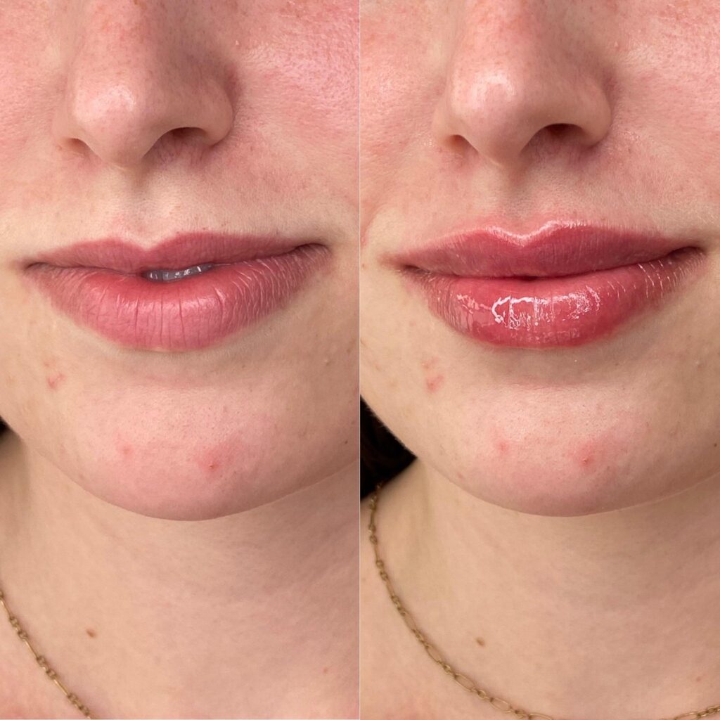 فیلر لب طبیعی (Natural Lips)