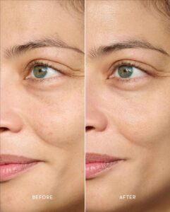 مزوژل زیر چشم؛ کاهش تیرگی و بهبود شادابی پوست