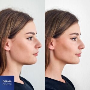 ماندگاری مادلینگ صورت چقدر است؟