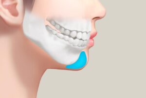 فیلر چانه یا پروتز چانه؟