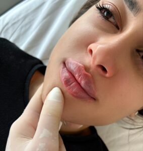 فیلر لب برای من مناسب