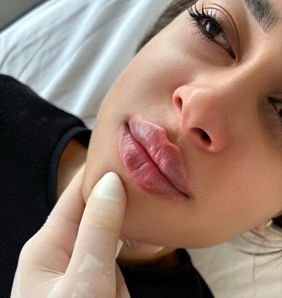 فیلر لب برای من مناسب