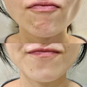 بوتاکس چانه برای رفع چانه سنگفرشی