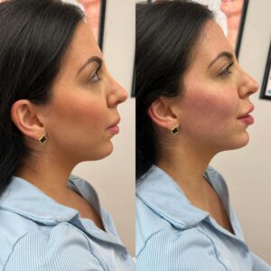 ماندگاری مادلینگ صورت چقدر است؟