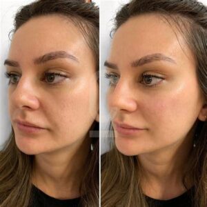فیلر گونه؛ لیفت و فرم‌دهی صورت